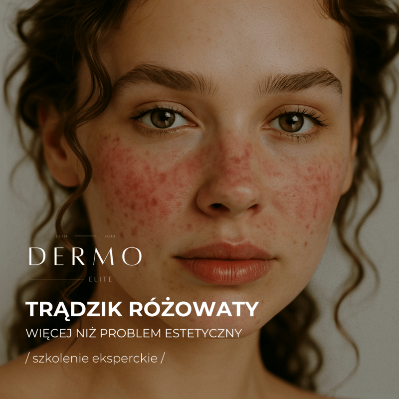 Trądzik różowaty – więcej niż problem estetyczny